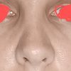 Inverted -V-deformity nosa