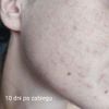 Skóra po radiofrekwencji mikroigłowej - czy można to odwrócić?