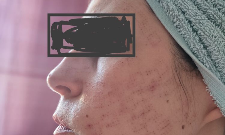 Skóra po radiofrekwencji mikroigłowej - czy można to odwrócić? - 82207