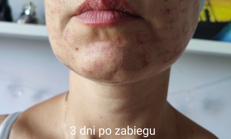 Skóra po radiofrekwencji mikroigłowej - czy można to odwrócić? - 82209