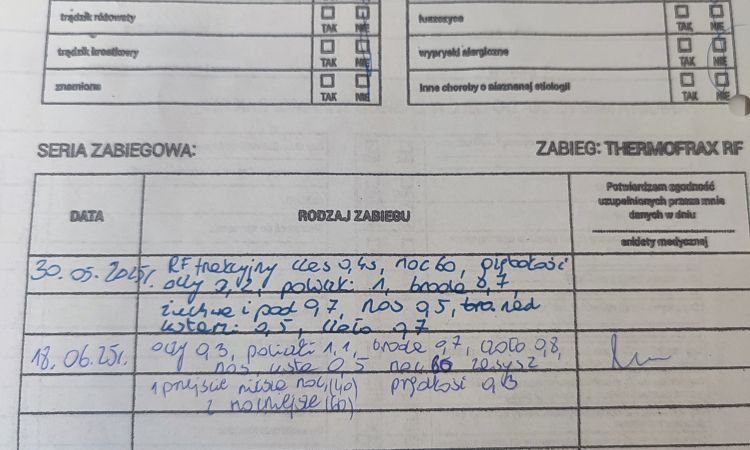 Skóra po radiofrekwencji mikroigłowej - czy można to odwrócić? - 82210
