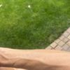 Czy można wykonać skleroterapię na bardzo widocznych żyłach na przedramionach?