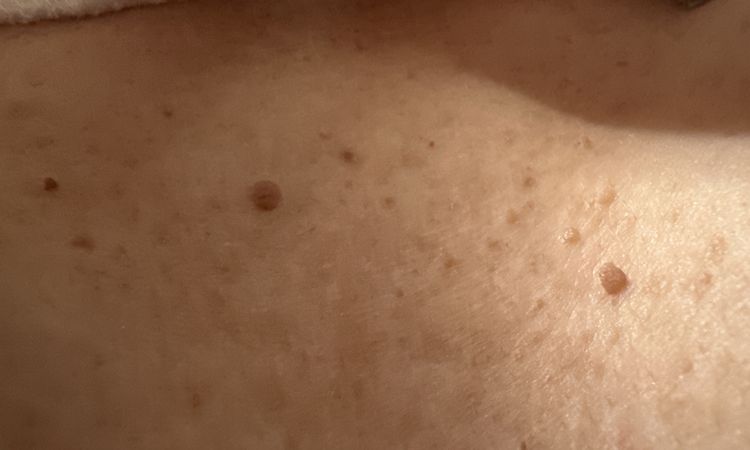 Wystające zmiany między piersiami - 82317