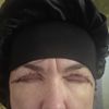 Niedomyklanosc powiek po blefaroplastyce