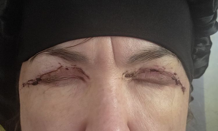 Niedomyklanosc powiek po blefaroplastyce - 82644