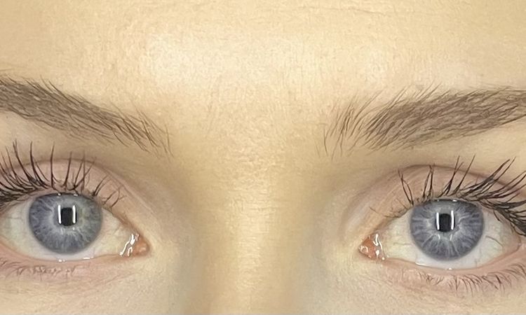 Opadnięty początek brwi z jednej strony - 82684