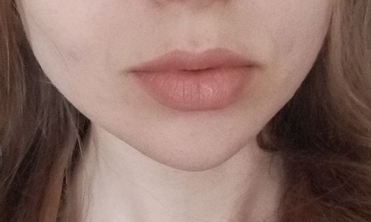 Nagły ból 2 lata po modelowaniu brody - 82749