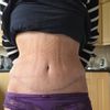 Abdominoplastyka psie uszy
