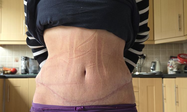 Abdominoplastyka psie uszy - 82760