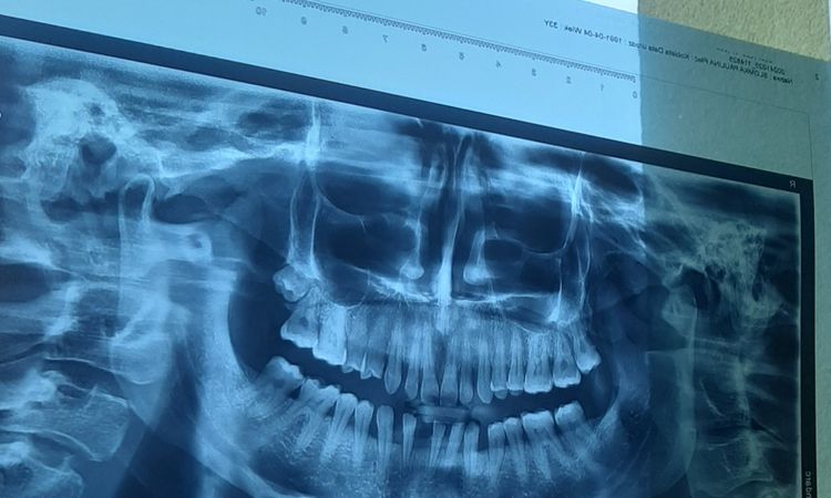 Wstawienie korony cyrkonowej na 6 zebach - 82825