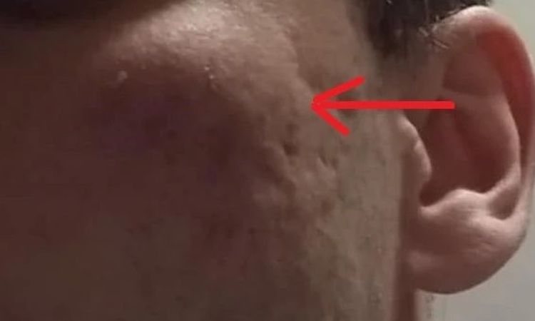 Leki, a zabiegi na bliznę - 82847