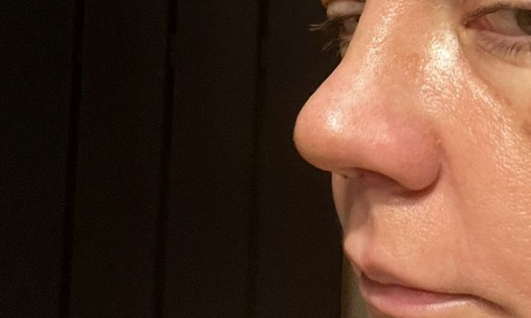 Załamana po operacji nosa - 82986