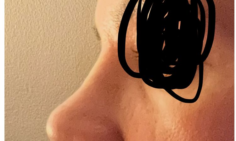 Załamana po operacji nosa - 82987