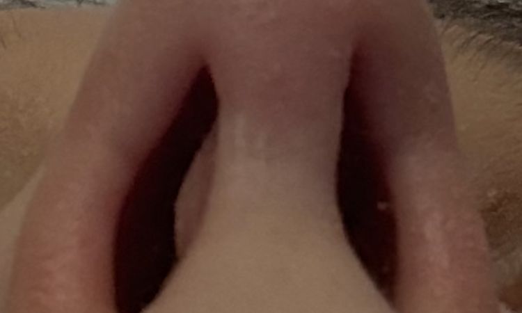 Operacja nosa po 4 miesiącach - dyskomfort - 83171