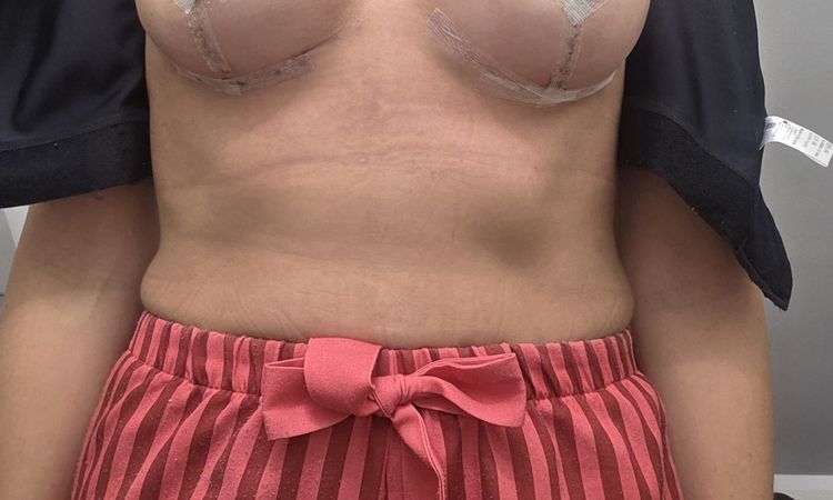 Asymetria piersi i objętość - 83205