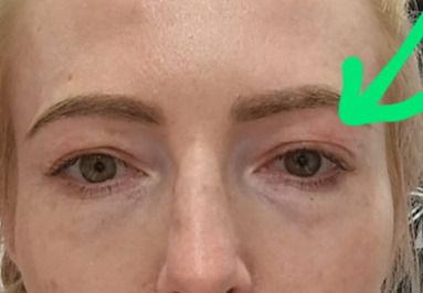 Większa asymetria po blefaroplastyce - 83217