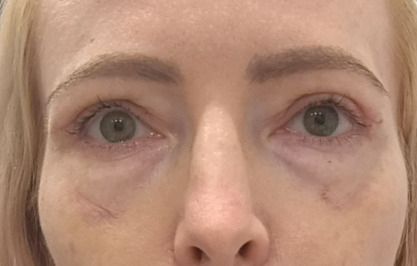 Większa asymetria po blefaroplastyce - 83218