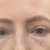 Większa asymetria po blefaroplastyce