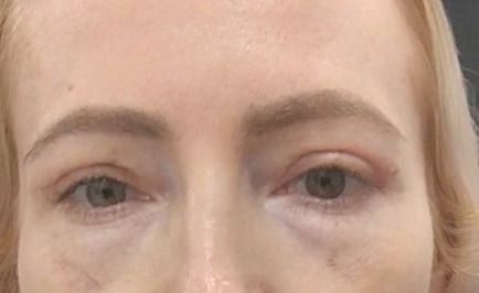 Większa asymetria po blefaroplastyce - 83219
