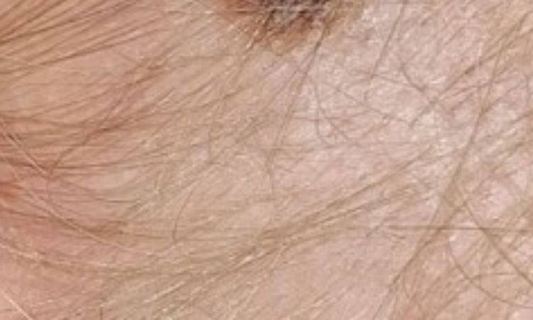 SWĘDZĄCY PIEPRZYK U DZIECKA - 83270