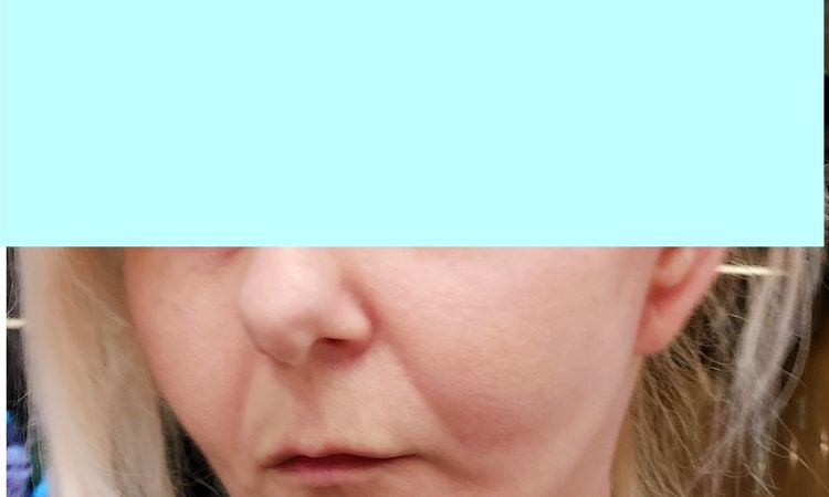 Deep Plane lift- jeden policzek większy - 83271