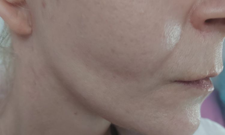 Deep Plane lift- jeden policzek większy - 83272