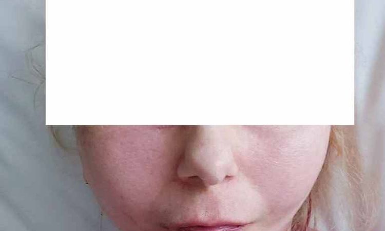 Dziwnie układający się jeden policzek po deep plane lift - 83337