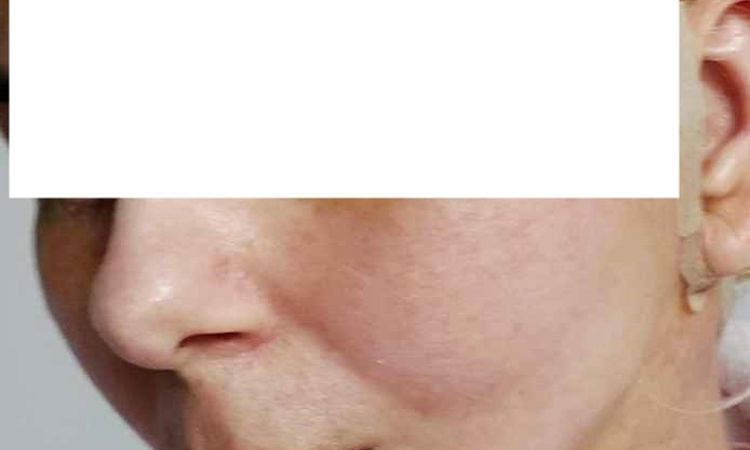 Dziwnie układający się jeden policzek po deep plane lift - 83338