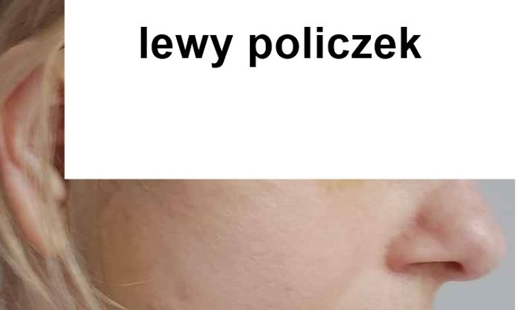 Dziwnie układający się jeden policzek po deep plane lift - 83339