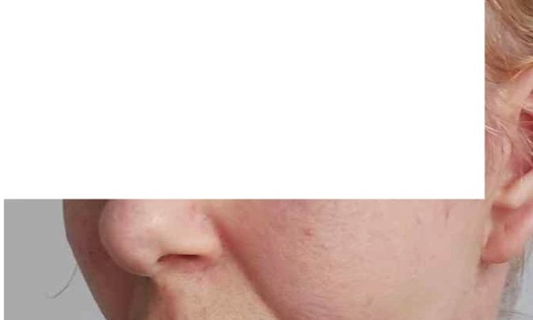 Dziwnie układający się jeden policzek po deep plane lift - 83340