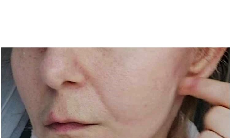 Dziwnie układający się jeden policzek po deep plane lift - 83341