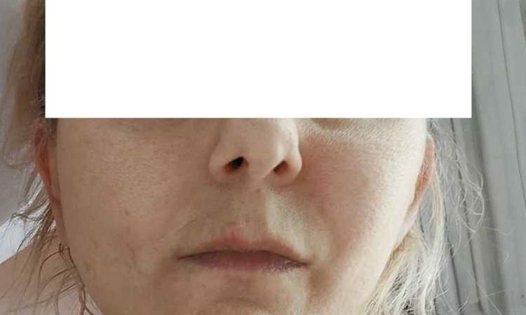 Dziwnie układający się jeden policzek po deep plane lift - 83342