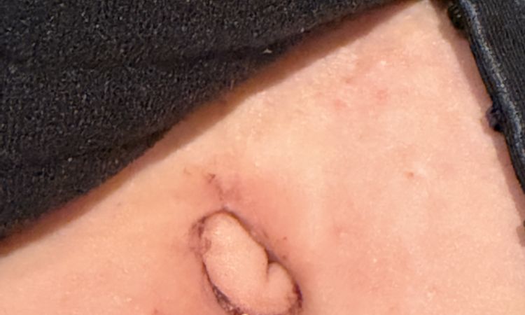 Pepek Po plastyce brzucha - 83357