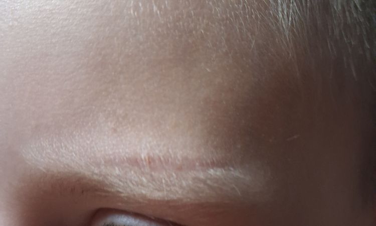 Brak efektu po laserowym usuwaniu blizny - 83372