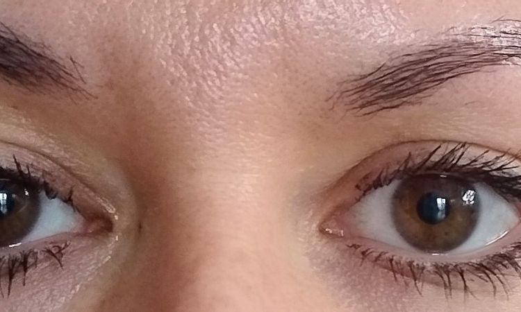 Operacja ptozy wrodzonej Łódź - 83499