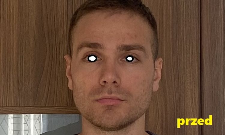 Nos się powiększył, po 8 latach od operacji? - 83571