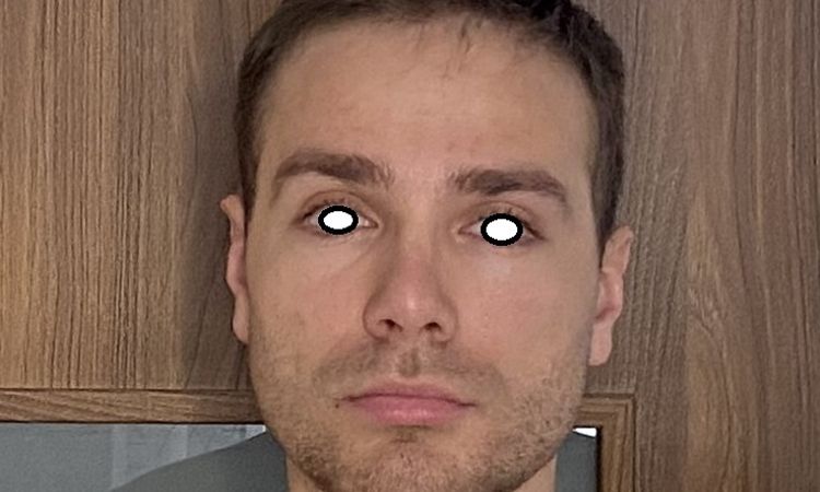 Nos się powiększył, po 8 latach od operacji? - 83572