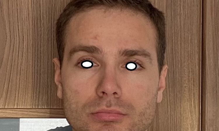 Nos się powiększył, po 8 latach od operacji? - 83573