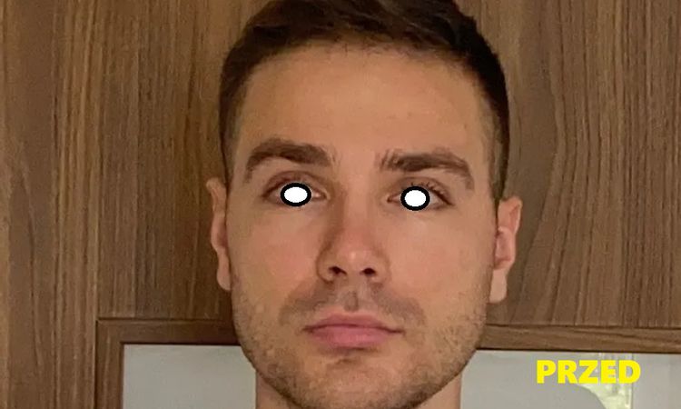 Nos się powiększył, po 8 latach od operacji? - 83574