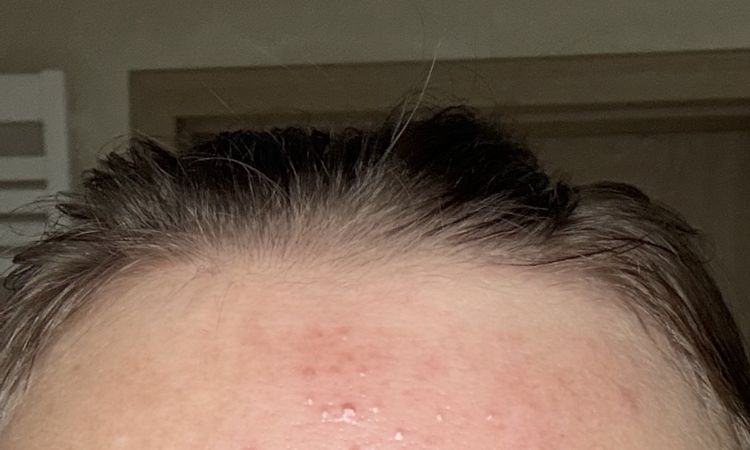 Chrosty po rf mikroiglowej - 83650