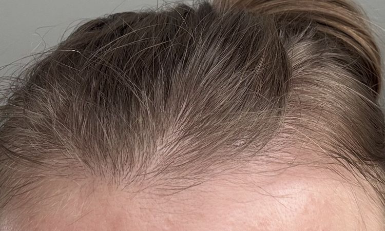 Chrosty po rf mikroiglowej - 83651