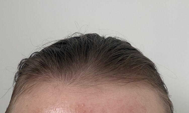 Chrosty po rf mikroiglowej - 83652