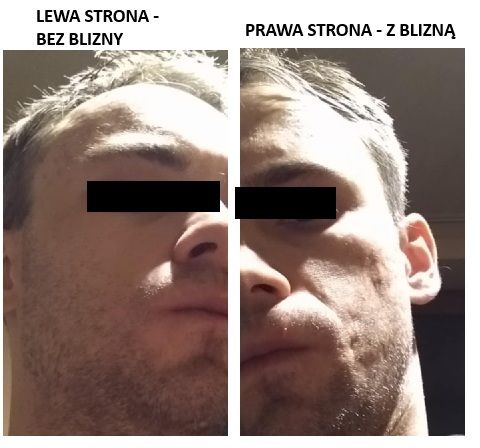 Zwłóknienie po trądziku podskórnym - 83655