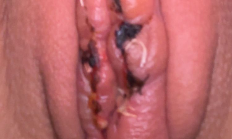 Labioplastyka - gigantyczny obrzęk po tygodniu dalej - 83737