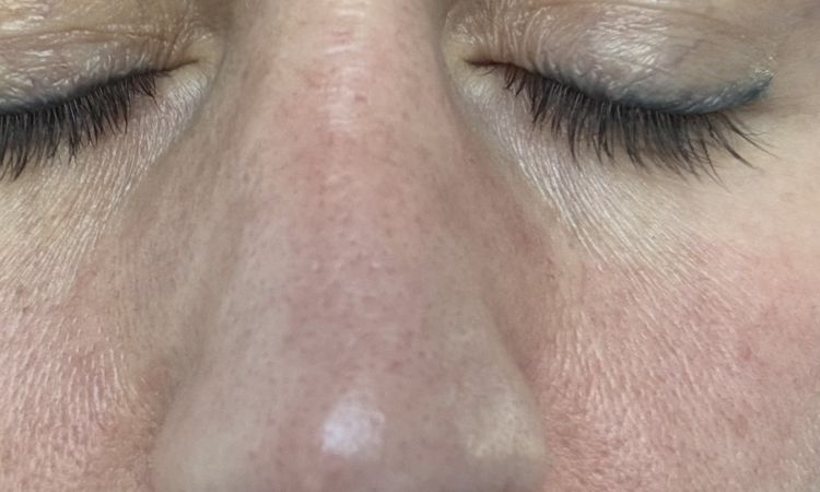 Gojenie nosa 2 lata po 3ciej operacji - 83747