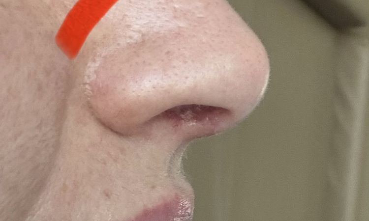 Gojenie nosa 2 lata po 3ciej operacji - 83748