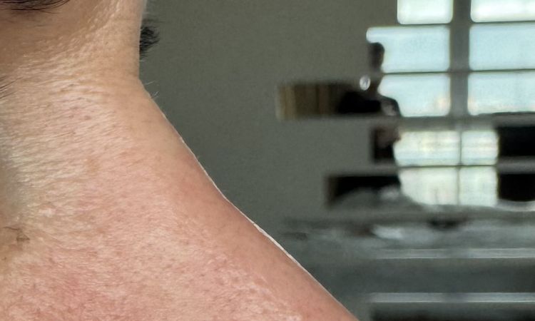 Gojenie nosa 2 lata po 3ciej operacji - 83749