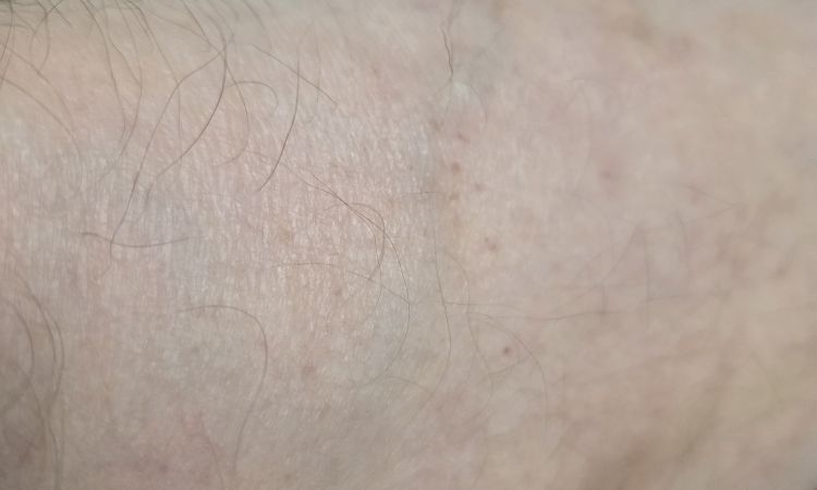 widoczne zylaki po zabiegu klejenia zyl. - 83799