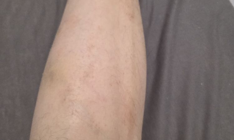 widoczne zylaki po zabiegu klejenia zyl. - 83801