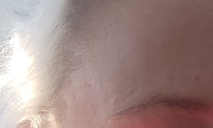 wypuklizna po blefaroplastike dolnych powiek - 83840